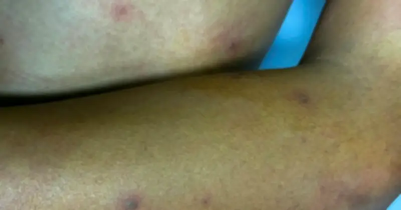Thiếu niên bị ong vò vẽ đốt 55 vết, sốc phản vệ nguy kịch