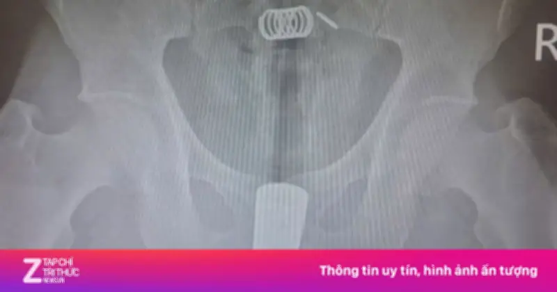 Đầu vòi xịt kẹt sâu trong trực tràng, bác sĩ mổ gần 2 giờ lấy thành công