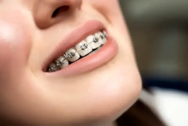 Vì sao người hiện đại phải niềng răng? Giải mã bí ẩn tiến hóa