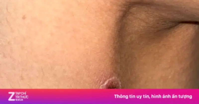 Vết đốt khô không đau ở khoeo chân cảnh báo sốt mò suy đa tạng