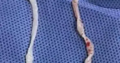 Đau cánh tay một năm vì thói quen dùng thớt chung: bác sĩ gắp hai con giun 10cm