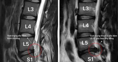 Đau lưng tê chân kéo dài: Nam sinh 23 tuổi phát hiện thoát vị đĩa đệm L5-S1