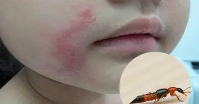 Bác sĩ Bạch Mai cảnh báo viêm da do kiến ba khoang: Cực độc, dễ nhầm zona