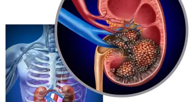 Bất ngờ phát hiện ung thư thận khi khám sức khỏe định kỳ ở tuổi 32