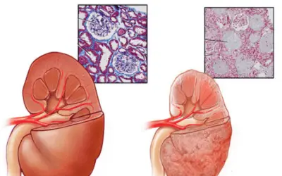 Cô gái 20 tuổi suy thận giai đoạn cuối vì chủ quan với dấu hiệu mới sáng