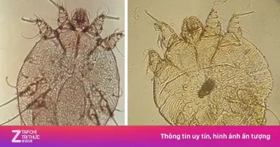 Dấu hiệu chứng tỏ bạn đã mắc bệnh ghẻ và cách nhận biết