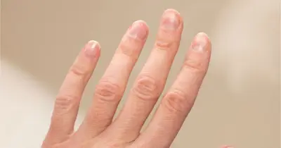 Dấu hiệu thiếu sắt trên móng tay: Bác sĩ kêu gọi đi khám ngay