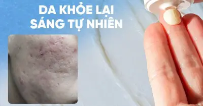 Kem Scar Esthetique của Rejuvaskin: Giải pháp làm mờ sẹo rỗ do mụn an toàn, hiệu quả