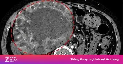 Khối u gan 2 cm tăng vọt lên 20 cm vì tự ý uống thuốc nam
