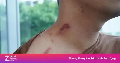 Kiến ba khoang mang độc tố như rắn hổ mang, xử trí sai nguy hiểm