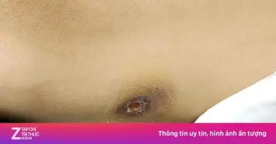 Nhiễm khuẩn Whitmore 'ăn thịt người', người phụ nữ nguy kịch sau 5 ngày