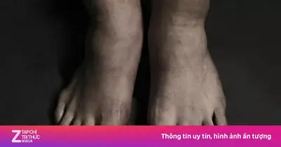 Phía sau đôi chân biến dạng của Son Heung-min: Nhỏ bé nhưng phi thường