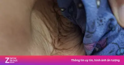 Phát hiện bệnh nguy hiểm từ vết loét nhỏ trên da cụ bà 88 tuổi