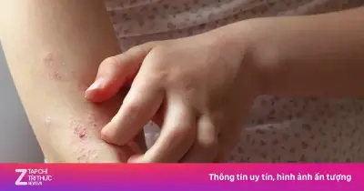 Phát hiện hai con giun sống dài 10 cm trong khối u tay người phụ nữ