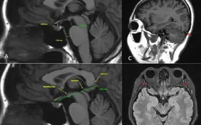 Phát hiện rò dịch não tủy hiếm gặp sau ba lần chụp MRI