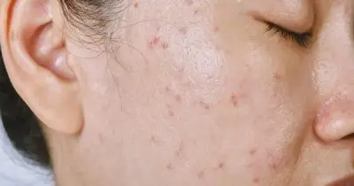 Sữa rửa mặt Trioderma Acne Deep Cleanser: Giải pháp cho da dầu mụn ở Việt Nam