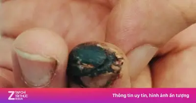 Tự đắp lá vào vết thương do cành cây, người bệnh tử vong vì uốn ván
