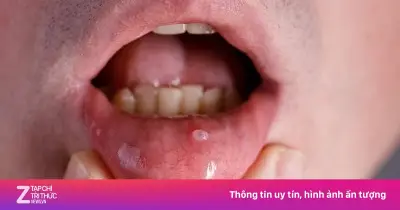 Tưởng nhiệt miệng, người đàn ông 53 tuổi phát hiện ung thư khoang miệng
