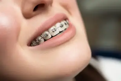 Vì sao người hiện đại phải niềng răng? Giải mã bí ẩn tiến hóa
