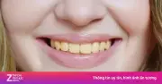 4 thực phẩm khiến răng ố vàng dù đánh răng thường xuyên
