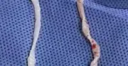 Đau cánh tay một năm vì thói quen dùng thớt chung: bác sĩ gắp hai con giun 10cm