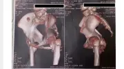 Bé gái 12 tuổi mắc hội chứng người hóa đá, thoát khỏi ca phẫu thuật nguy hiểm