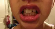 Bé gái lớp 5 bị gãy răng cửa, bố mẹ làm ngay 1 việc mà bác sĩ cũng khen thông minh