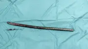 Bác sĩ Việt Đức lấy thành công thanh xà beng xuyên đùi bệnh nhân
