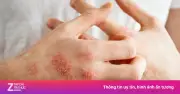 Bệnh vảy nến thể mủ toàn thân: 'Cơn bão viêm' nguy hiểm đe dọa tính mạng