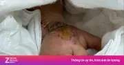 Báo động đỏ cứu bàn tay đứt lìa cho bé 2 tuổi bị máy dập nắp cốc
