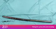 Ca mổ kịch tính: Rút xà beng 1,5m xuyên đùi bệnh nhân