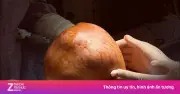 Chịu đựng khối u vú nặng 3,5 kg, người phụ nữ phải phẫu thuật gấp