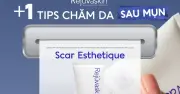Da sau mụn: Thâm và sẹo rỗ không phải do thiếu dưỡng chất