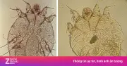 Dấu hiệu chứng tỏ bạn đã mắc bệnh ghẻ và cách nhận biết