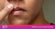 Dấu hiệu ung thư miệng dễ bị bỏ qua do nhầm với bệnh răng miệng