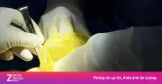 Hai loại túi ngực trên cùng cơ thể: Sự khác biệt sau 14 năm