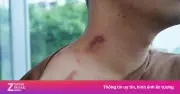 Kiến ba khoang mang độc tố như rắn hổ mang, xử trí sai nguy hiểm