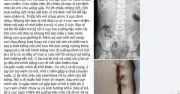 Nghệ An yêu cầu báo cáo vụ bé nuốt nam châm, mổ lấy 1 viên