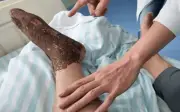 Người đàn ông bị rắn lục độc cắn khi cấy lúa, sơ cứu đúng cách thoát nguy
