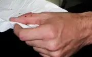 Người đàn ông bị rắn ngũ bộ cắn khi lấy xe, chụp ảnh cứu mạng