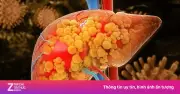 Nhận biết ung thư gan từ sớm qua các dấu hiệu cảnh báo