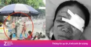 Nạn nhân bị xịt nước cao áp vào mặt vẫn chưa mở được mắt