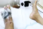 Đắp lá chữa bỏng, người đàn ông tiểu đường mất 3 ngón chân