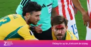Rách mặt vẫn chiến đấu: Metcalfe khiến World Cup dậy sóng