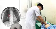 Sự cố hy hữu: Mẹ nhổ răng tại nhà, bé trai phải cấp cứu