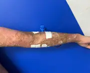 Thuốc sinh học thế hệ mới điều trị bệnh vảy nến thể mủ hiệu quả
