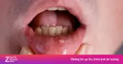 Tưởng nhiệt miệng, người đàn ông 53 tuổi phát hiện ung thư khoang miệng