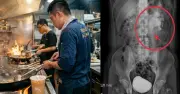 Đầu bếp 32 tuổi phù thận cấp vì uống trà sữa thay nước lọc