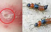 Viêm da do kiến ba khoang: Dễ nhầm với zona, xử lý sai gây nhiễm trùng