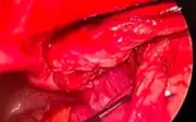 Xương lợn đâm thủng ruột: Hai trẻ nguy kịch vì nuốt dị vật